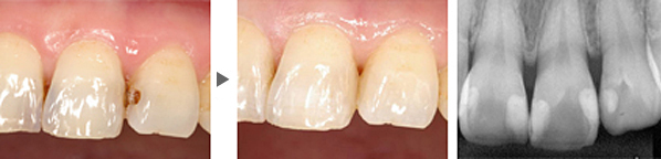 前歯の虫歯の治療(レジン充填)