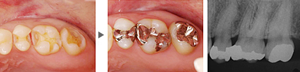 奥歯の虫歯の治療(インレー修復)