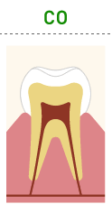 虫歯の進行度（図）
