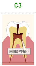 虫歯の進行度（図）